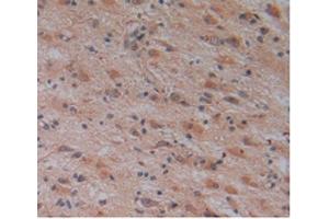 Detection of CRN in Human Glioma Tissue using Polyclonal Antibody to Corin (CRN)