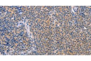 Immunohistochemistry of paraffin-embedded Human Lymphoma using CCL16 Polyclonal Antibody at dilution of 1:50 (CCL16 anticorps)