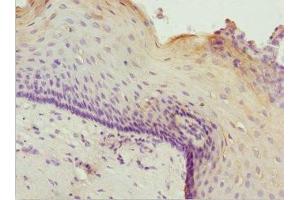 Immunohistochemistry of paraffin-embedded human cervical cancer using ABIN7176007 at dilution of 1:100 (ZNF187 anticorps  (AA 239-478))