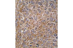 Formalin-fixed and paraffin-embedded human lung carcinoma tissue reacted with GIT1 Antibody  (ABIN391615 and ABIN2841536) , which was peroxidase-conjugated to the secondary antibody, followed by DAB staining. (GIT1 anticorps  (AA 487-517))