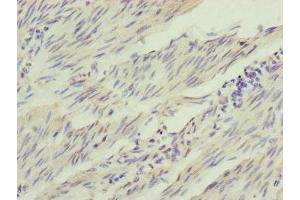 Immunohistochemistry of paraffin-embedded human bladder cancer using ABIN7156905 at dilution of 1:100 (IL1F9 anticorps  (AA 1-169))