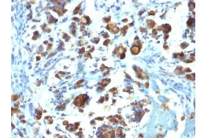 Formalin-fixed, paraffin-embedded human Gastric Carcinoma stained with MUC3 Monoclonal Antibody (MUC3/1154). (MUC3A anticorps)