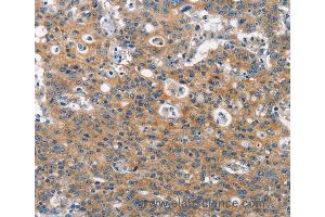 Immunohistochemistry of Human gastric cancer using CLTC Polyclonal Antibody at dilution of 1:60 (Clathrin Heavy Chain (CLTC) anticorps)