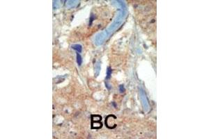 Formalin-fixed and paraffin-embedded human cancer tissue reacted with the primary antibody, which was peroxidase-conjugated to the secondary antibody, followed by DAB staining.