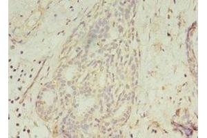 Immunohistochemistry of paraffin-embedded human breast cancer using ABIN7154452 at dilution of 1:100 (GCC1 anticorps  (AA 4-775))