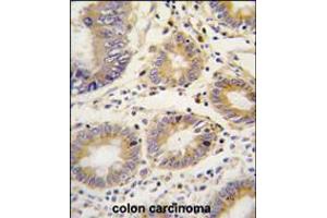 Formalin-fixed and paraffin-embedded human colon carcinoma tissue reacted with LEFTB antibody , which was peroxidase-conjugated to the secondary antibody, followed by DAB staining.