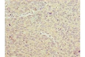 Immunohistochemistry of paraffin-embedded human cervical cancer using ABIN7153904 at dilution of 1:100 (PGM2L1 anticorps  (AA 101-400))