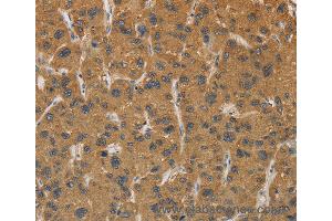 Immunohistochemistry of Human gastric cancer using CYP17A1 Polyclonal Antibody at dilution of 1:30 (CYP17A1 anticorps)