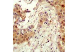 Immunohistochemical analysis of AKT2 (pS474) staining in human breast cancer formalin fixed paraffin embedded tissue section. (AKT2 anticorps  (C-Term, pSer474))