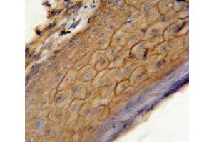 CB2 antibody immunohistochemistry analysis in formalin fixed and paraffin embedded human skin carcinoma. (CNR2 anticorps  (AA 329-356))