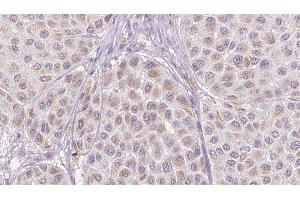 ABIN6276733 at 1/100 staining Human melanoma tissue by IHC-P. (SERPINC1 anticorps  (Internal Region))