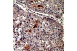 Immunohistochemical analysis of TRIF staining in human lung cancer formalin fixed paraffin embedded tissue section. (TICAM1 anticorps  (C-Term))