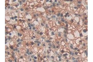 Detection of SPRY3 in Human Renal cancer Tissue using Polyclonal Antibody to Sprouty Homolog 3 (SPRY3)