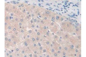 IHC-P analysis of Human Liver cancer Tissue, with DAB staining. (GALC anticorps  (AA 375-535))