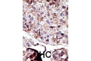 Formalin-fixed and paraffin-embedded human cancer tissue reacted with the primary antibody, which was peroxidase-conjugated to the secondary antibody, followed by AEC staining.