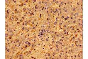 Immunohistochemistry of paraffin-embedded human liver cancer using ABIN7162453 at dilution of 1:100 (P2RY1 anticorps  (AA 329-373))