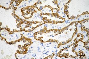 Immunohistochemistry was performed on paraffin-embedded human lung adenocarcinoma using keratin 7 antibody (ABIN7799188), 1:200).