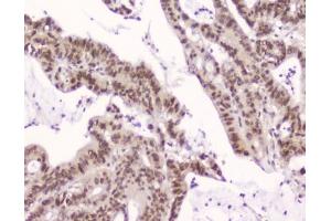IHC testing of FFPE human intestinal cancer with XPO1 antibody at 2ug/ml. (XPO1 anticorps  (AA 966-1071))