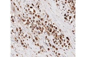 ABIN6266856 at 1/100 staining human Breast cancer tissue sections by IHC-P. (IRX2 anticorps  (Internal Region))