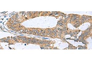 Immunohistochemistry of paraffin-embedded Human colorectal cancer tissue using HPCAL1 Polyclonal Antibody at dilution of 1:70(x200) (HPCAL1 anticorps)