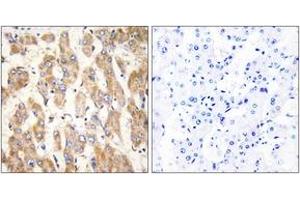 Immunohistochemistry analysis of paraffin-embedded human liver carcinoma, using BAX Antibody. (BAX anticorps  (AA 41-90))