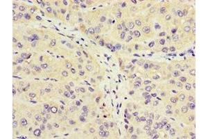 Immunohistochemistry of paraffin-embedded human liver cancer using ABIN7162964 at dilution of 1:100