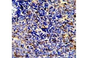 IHC analysis of FFPE human lymphoma stained with MERTK antibody (MERTK anticorps)