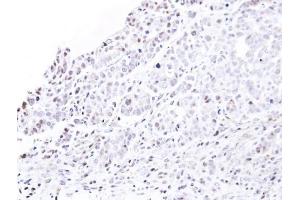 IHC-P Image Immunohistochemical analysis of paraffin-embedded NCIN87 xenograft, using nucleoporin p62 , antibody at 1:500 dilution.