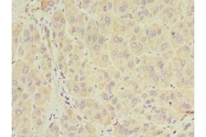 Immunohistochemistry of paraffin-embedded human liver cancer using ABIN7155026 at dilution of 1:100 (SERPIND1 anticorps  (AA 20-290))