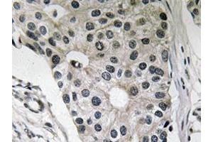 Immunohistochemistry analyzes of Ob antibody in paraffin-embedded human breast carcinoma tissue. (Leptin anticorps)