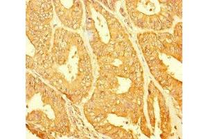 Immunohistochemistry of paraffin-embedded human endometrial cancer using ABIN7147689 at dilution of 1:100 (CHTOP anticorps  (AA 179-248))