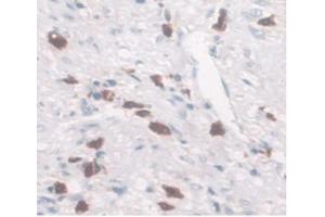 DAB staining on IHC-P Samples:Human Rectum Cancer Tissue.