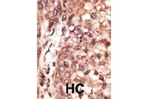 Formalin-fixed and paraffin-embedded human hepatocellular carcinoma tissue reacted with CREB3L1 polyclonal antibody  , which was peroxidase-conjugated to the secondary antibody, followed by DAB staining. (CREB3L1 anticorps  (C-Term))
