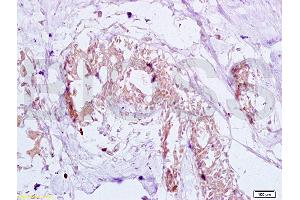 Formalin-fixed and human breast carcinoma tissue labeled with Anti-GTPBP10 Polyclonal Antibody (ABIN750748), Unconjugated at 1:200 followed by conjugation to the secondary antibody and DAB staining