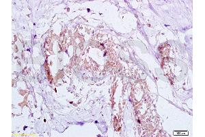 Formalin-fixed and human breast carcinoma tissue labeled with Anti-GTPBP10 Polyclonal Antibody (ABIN750748), Unconjugated at 1:200 followed by conjugation to the secondary antibody and DAB staining (GTPBP10 anticorps  (AA 151-250))