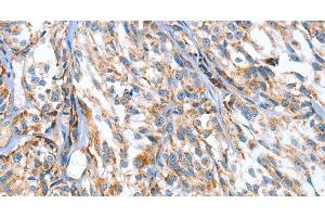 Immunohistochemistry of paraffin-embedded Human esophagus cancer using APOBEC3D Polyclonal Antibody at dilution of 1:80 (APOBEC3D anticorps)
