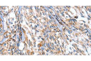 Immunohistochemistry of paraffin-embedded Human esophagus cancer using APOBEC3D Polyclonal Antibody at dilution of 1:80 (APOBEC3D anticorps)