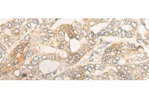 Immunohistochemistry of paraffin-embedded Human liver cancer tissue using DUOX2 Polyclonal Antibody at dilution of 1:40(x200) (DUOX2 anticorps)