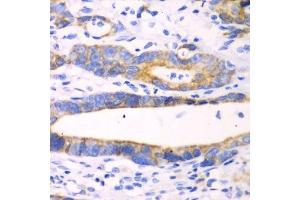 Immunohistochemistry of paraffin-embedded human gastric cancer using CHIA antibody. (CHIA anticorps  (AA 1-368))