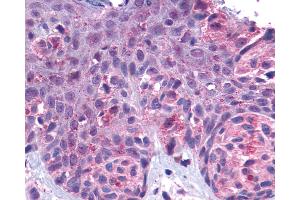 Anti-GPR162 antibody IHC of human Skin, Melanoma.