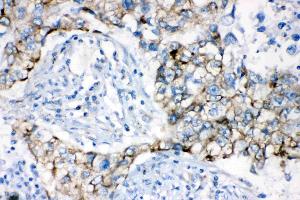 AK2 was detected in paraffin-embedded sections of human lung cancer tissues using rabbit anti- AK2 Antigen Affinity purified polyclonal antibody (Catalog # ) at 1 µg/mL. (Adenylate Kinase 2 anticorps  (AA 161-239))