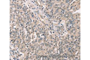 Immunohistochemistry of Human cervical cancer using CDK12 Polyclonal Antibody at dilution of 1:30 (CDK12 anticorps)