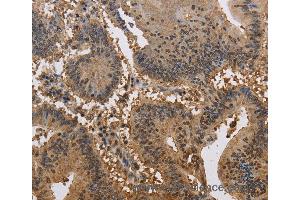 Immunohistochemistry of Human liver cancer using JAG2 Polyclonal Antibody at dilution of 1:30 (JAG2 anticorps)