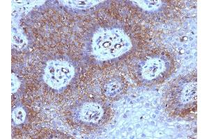 Formalin-fixed, paraffin-embedded human Cervical Carcinoma stained with Beta-2-Microglobulin Mouse Monoclonal Antibody (B2M/961).
