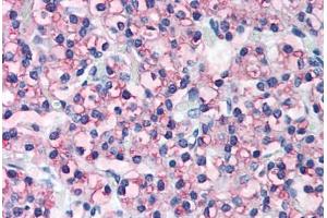 Human Parathyroid (formalin-fixed, paraffin-embedded) stained with PTH antibody ABIN305746 at 5 ug/ml followed by biotinylated anti-goat IgG secondary antibody ABIN481715, alkaline phosphatase-streptavidin and chromogen.