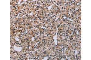 Immunohistochemistry of Human lung cancer using PNPT1 Polyclonal Antibody at dilution of 1:40 (PNPT1 anticorps)