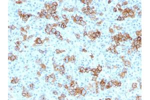 Formalin-fixed, paraffin-embedded human Hodgkin's Lymphoma stained with CD30 Monoclonal Antibody (Ki-1/779). (TNFRSF8 anticorps)