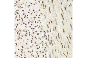Immunohistochemistry of paraffin-embedded human adenoma of uterine muscle using HNRNPD Antibody.