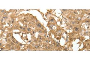 Immunohistochemistry of paraffin-embedded Human lung cancer using TXN Polyclonal Antibody at dilution of 1:40 (TXN anticorps)