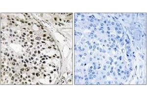 Immunohistochemistry analysis of paraffin-embedded human breast carcinoma tissue, using MNK1 (Ab-250) Antibody. (MKNK1 anticorps  (AA 216-265))